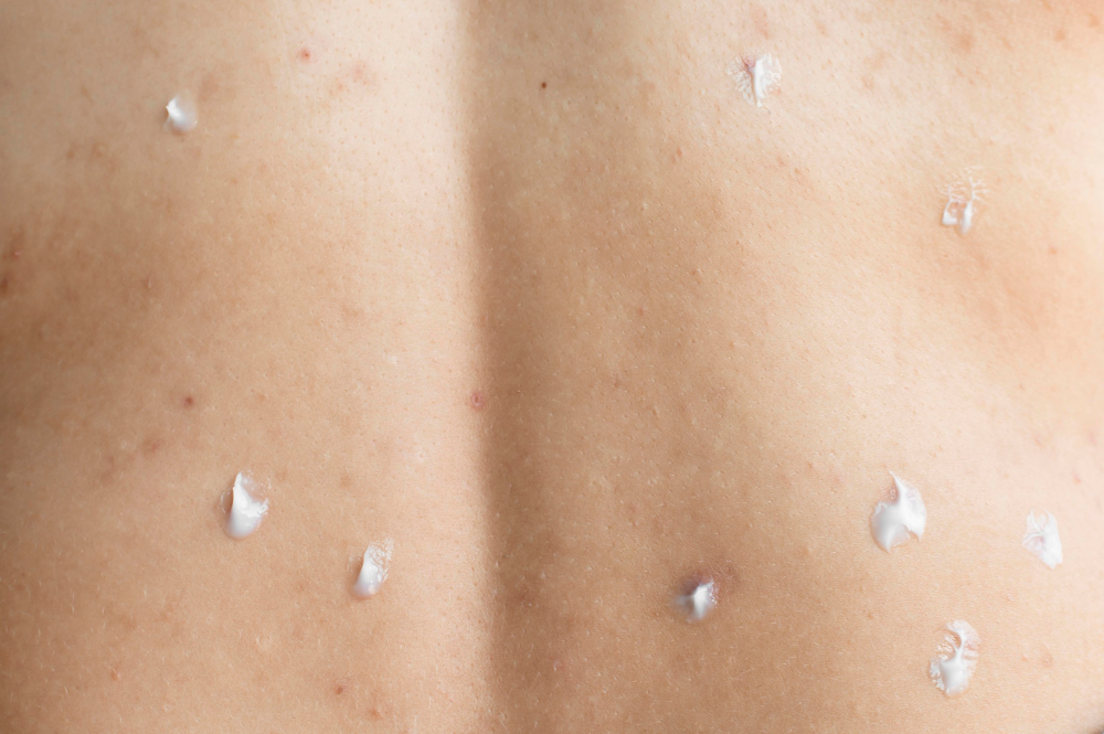 Allergy Test